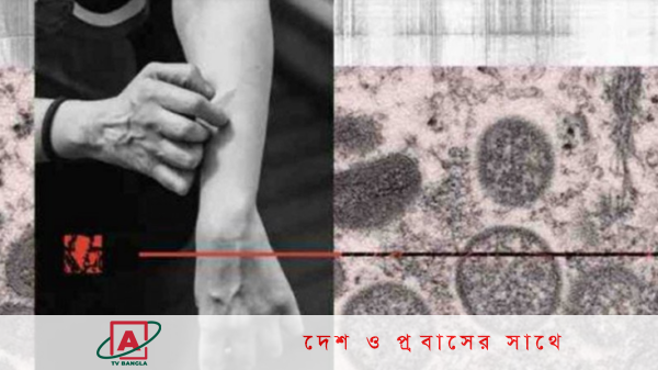 মাঙ্কিপক্স : ওয়াশিংটনের কিং কাউন্টিতে জরুরি অবস্থা